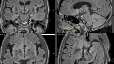 MR image of the brain